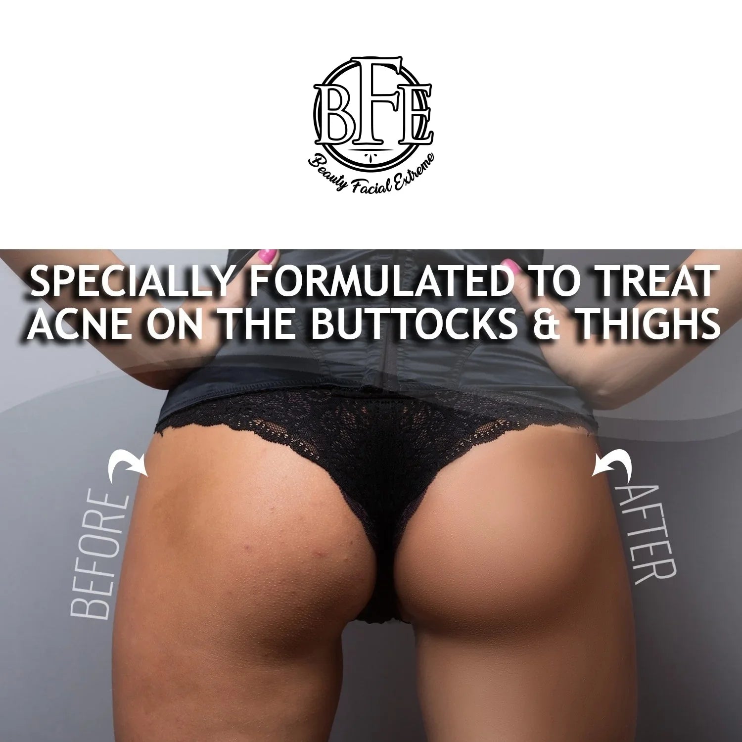 Anti-Acne Buttocks & Thigh Treatment- Clears Away Acne, Pimples, and Ingrown Hairs for the Buttocks and Thigh Area. Prevents Future Breakouts. 6.9 OZ